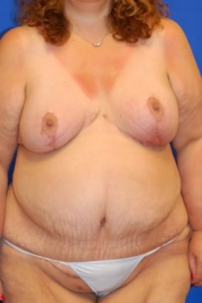 Breast Reduction