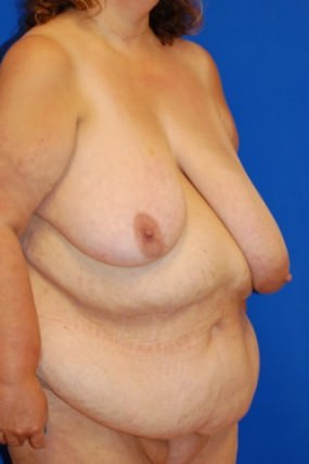 Breast Reduction