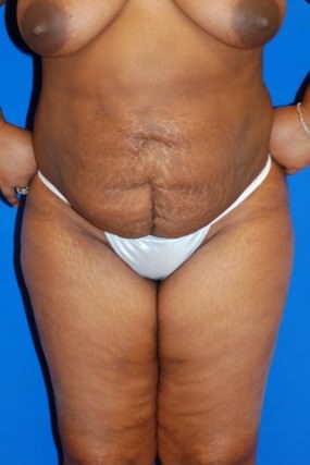 Liposuction Case 3375-Liposuction After Photo Liposuction