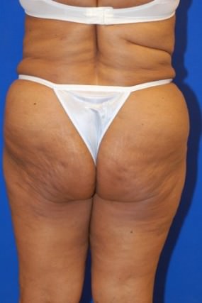 Liposuction