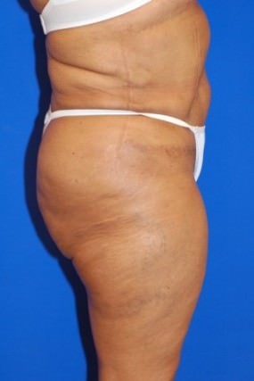 Liposuction