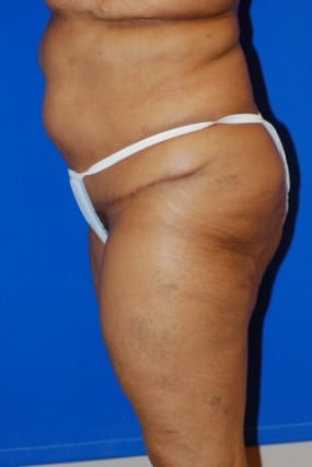 Liposuction