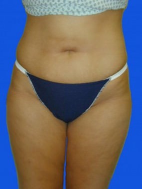 Liposuction