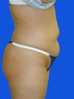 Liposuction