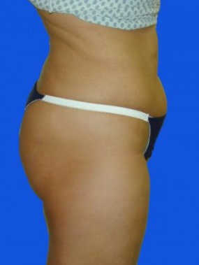 Liposuction