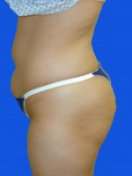 Liposuction