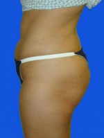 Liposuction