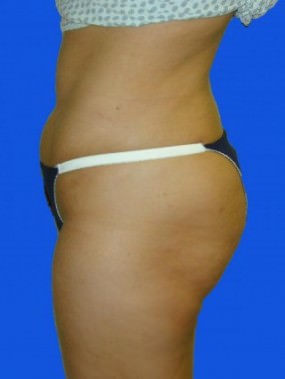 Liposuction