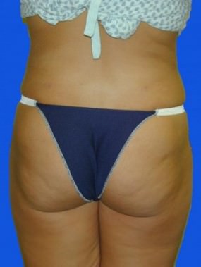 Liposuction