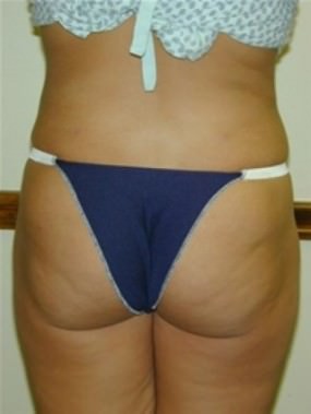 Liposuction