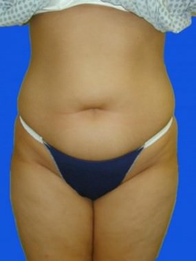 Liposuction