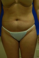 Liposuction