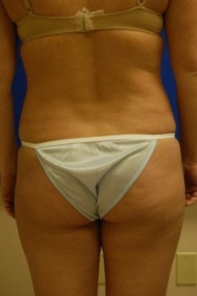Liposuction Case 3402- liposuction Before Photo Liposuction