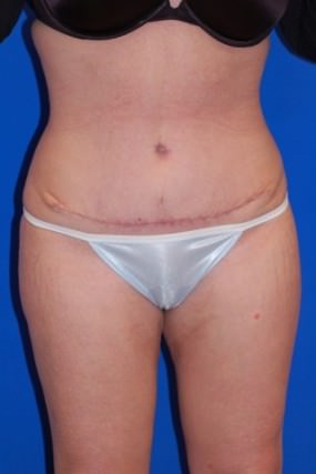 Liposuction