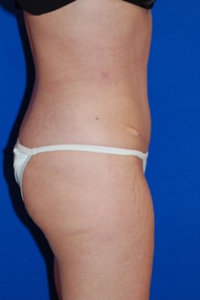 Liposuction