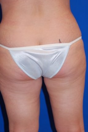 Liposuction Case 3411- Liposuction After Photo Liposuction
