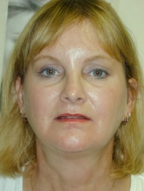 Liposuction Case 3420- liposuction After Photo Liposuction