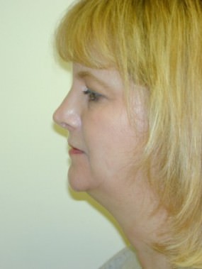 Liposuction Case 3420- liposuction Before Photo Liposuction