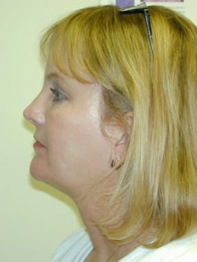 Liposuction Case 3420- liposuction After Photo Liposuction