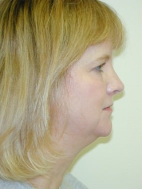 Liposuction Case 3420- liposuction Before Photo Liposuction