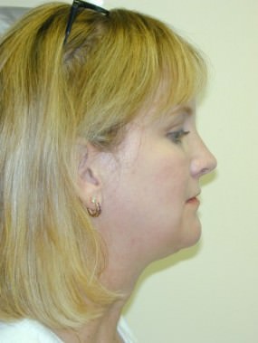 Liposuction Case 3420- liposuction After Photo Liposuction