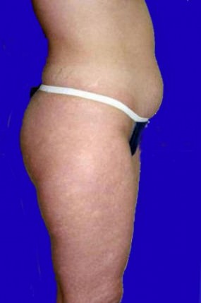 Liposuction Case 3427- liposuction Before Photo Liposuction