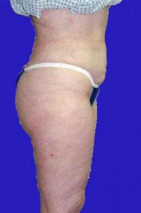 Liposuction Case 3427- liposuction After Photo Liposuction
