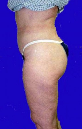 Liposuction Case 3427- liposuction After Photo Liposuction