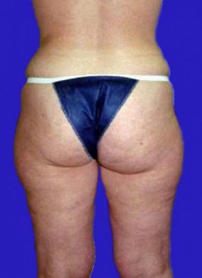Liposuction Case 3427- liposuction Before Photo Liposuction