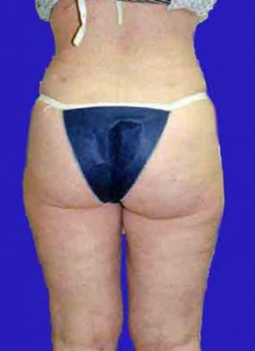 Liposuction Case 3427- liposuction After Photo Liposuction
