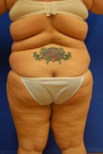 Liposuction