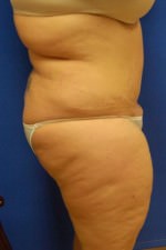 Liposuction