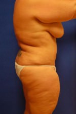 Liposuction