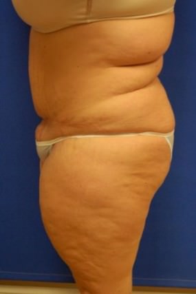 Liposuction Case 3445- liposuction Before Photo Liposuction