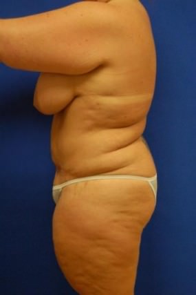 Liposuction Case 3445- liposuction After Photo Liposuction