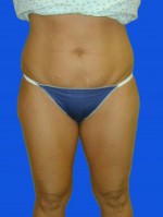 Liposuction