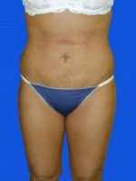 Liposuction