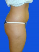 Liposuction