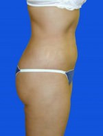 Liposuction