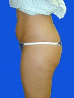 Liposuction Case 3452- liposuction Before Photo Liposuction