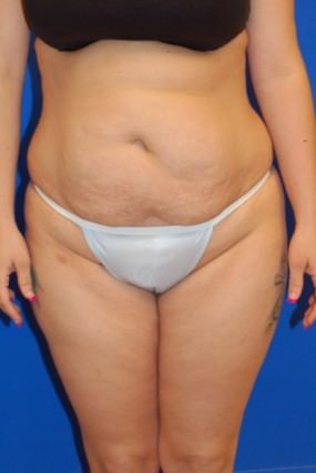 Tummy Tuck