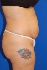 Tummy Tuck