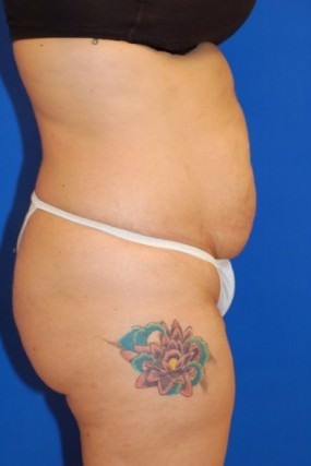 Tummy Tuck
