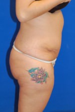 Tummy Tuck