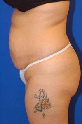 Tummy Tuck