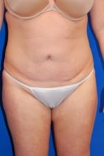 Tummy Tuck
