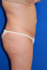 Tummy Tuck