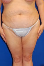Tummy Tuck