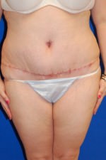 Tummy Tuck