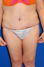 Tummy Tuck